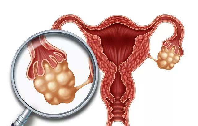 婦科“第一兇癌”！當出現這些癥狀時，婦科問題艾灸灸什么穴位